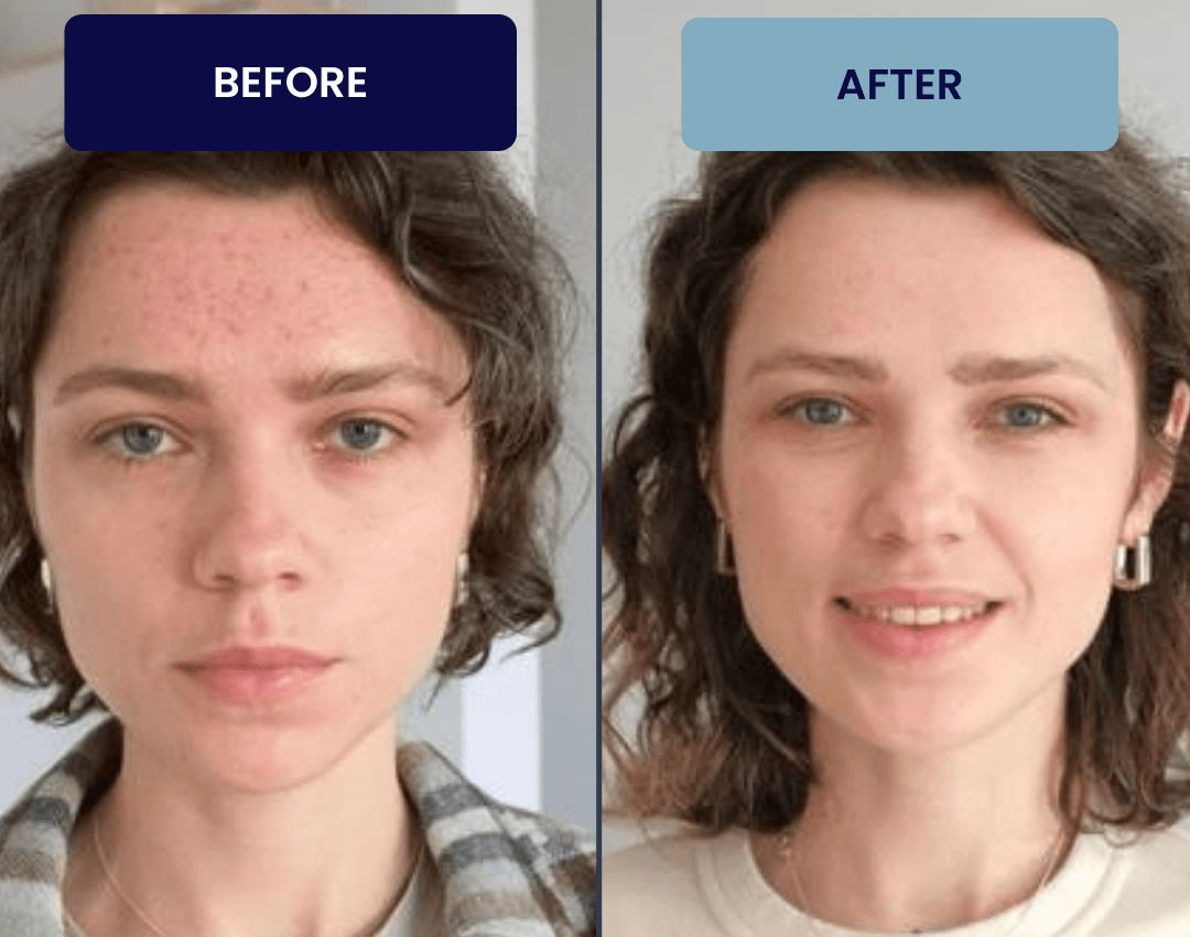 Before & After using Agesify hydrogen water bottle. Get Glowing Skin With out Side Effects.